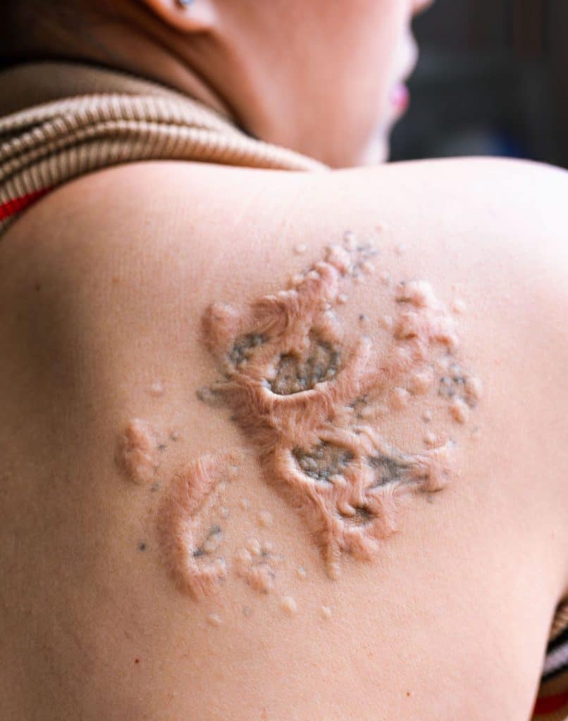 a woman with a tattoo infection on her back