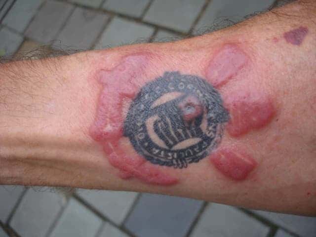 tattoo-red-reaction